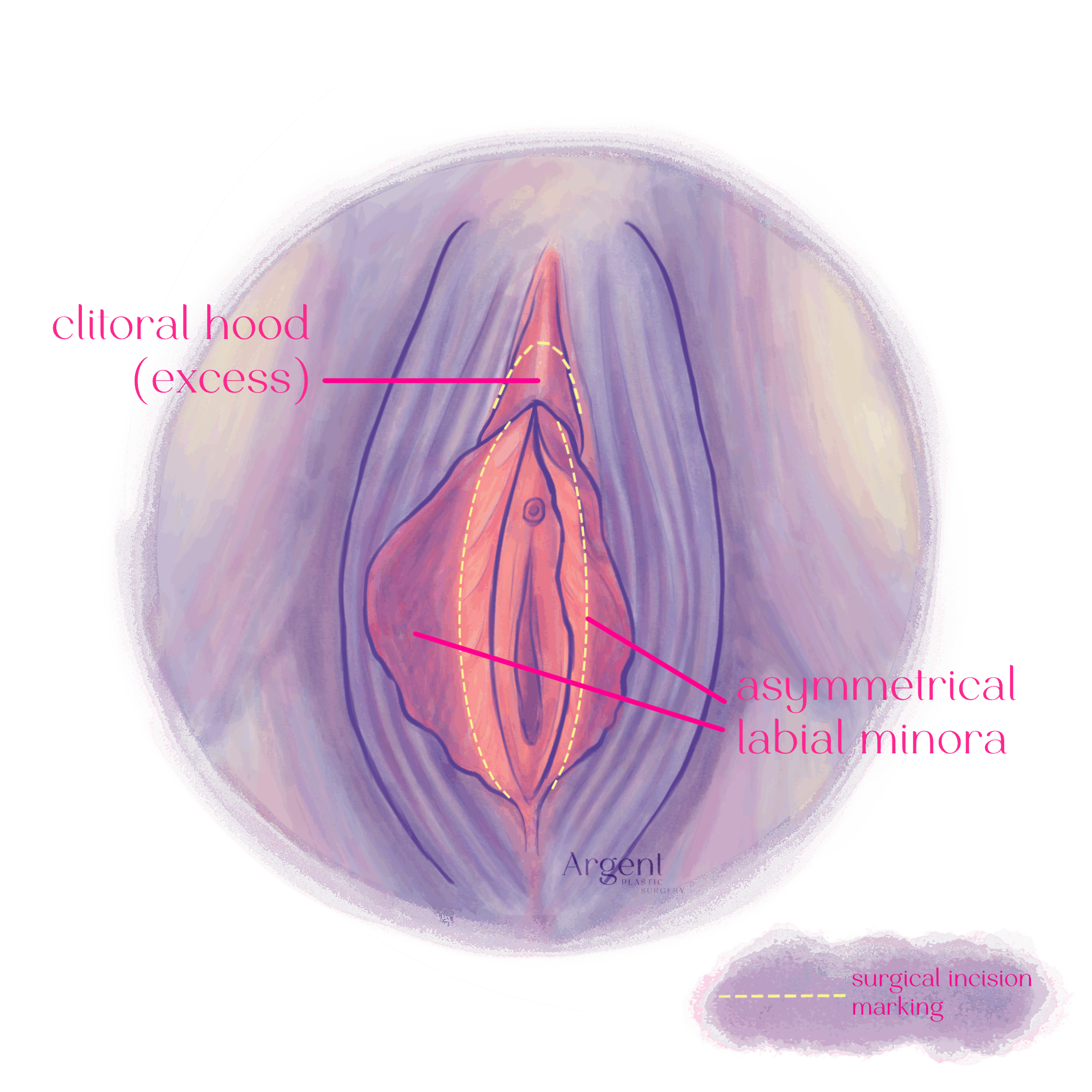 Excess Clitoral Hood Asymmetrical Labial Minora_Label n Legend_Transparent