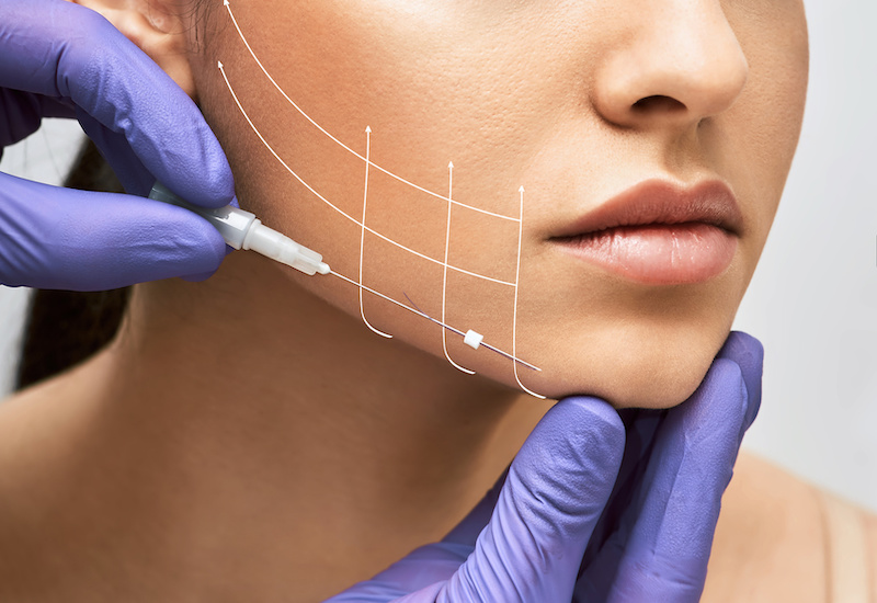 Thread or face lift - Expat Living