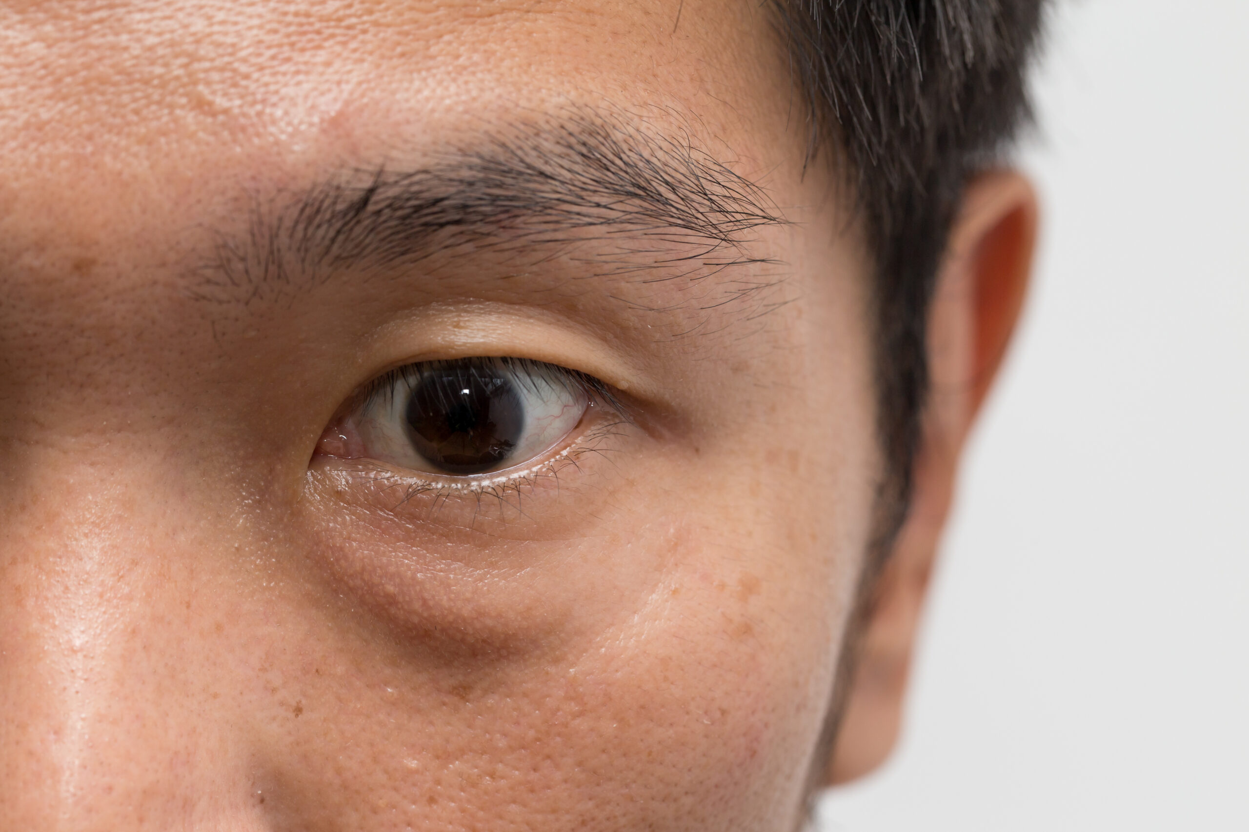 Eye Bag Surgery Recovery