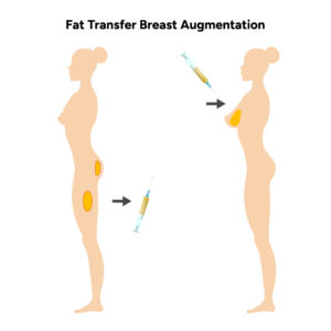 Why Some Women Choose Fat Transfer For Breast Augmentation?