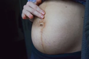 Postpartum woman with diastasis recti.