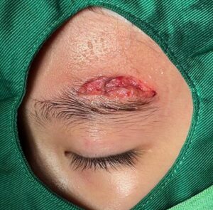 eye brow laceration