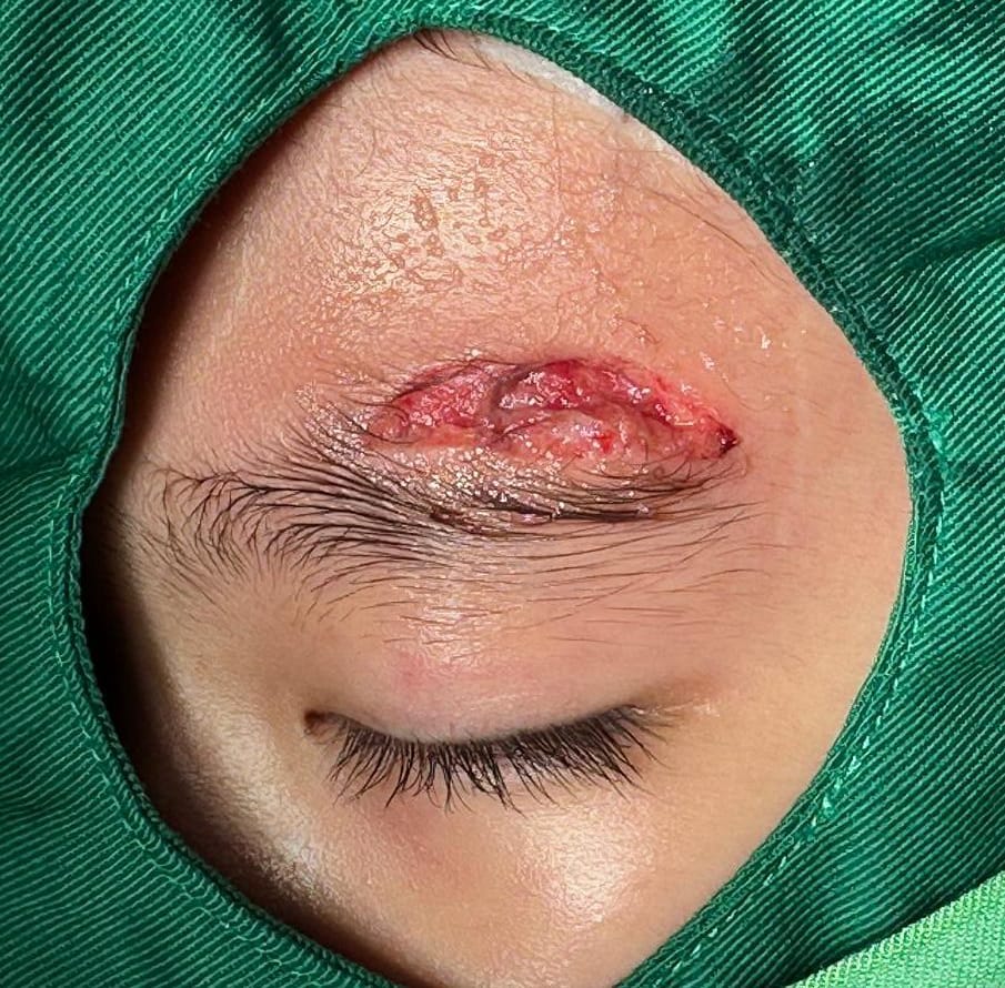eye brow laceration