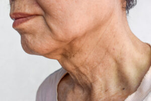 Aging skin folds or skin creases or wrinkles at neck