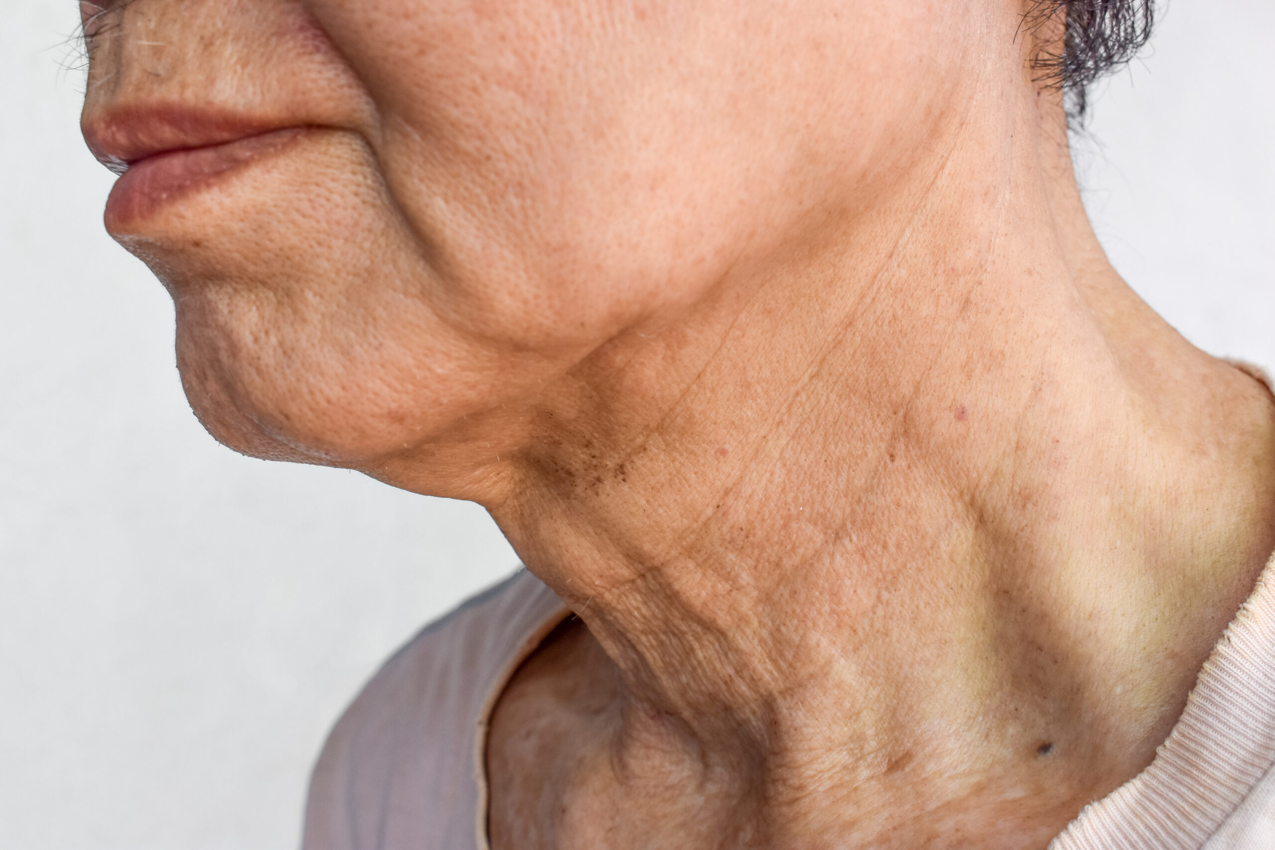 Aging skin folds or skin creases or wrinkles at neck
